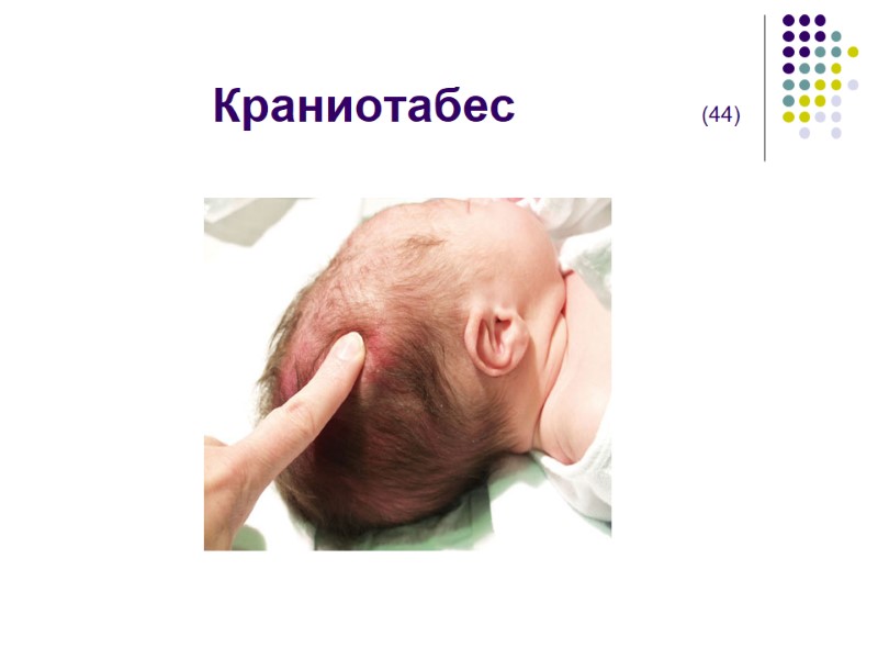 Краниотабес             